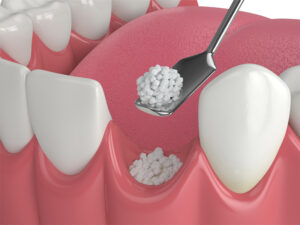 Dental Bone Grafting - Westhill Dental - Greenville, Wi